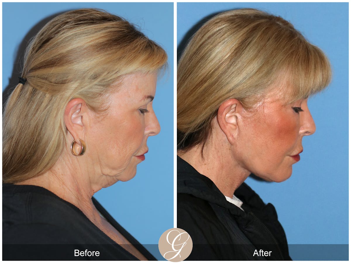 Preservation Facelift Before & After Gallery - Patient 220003 - Image 6