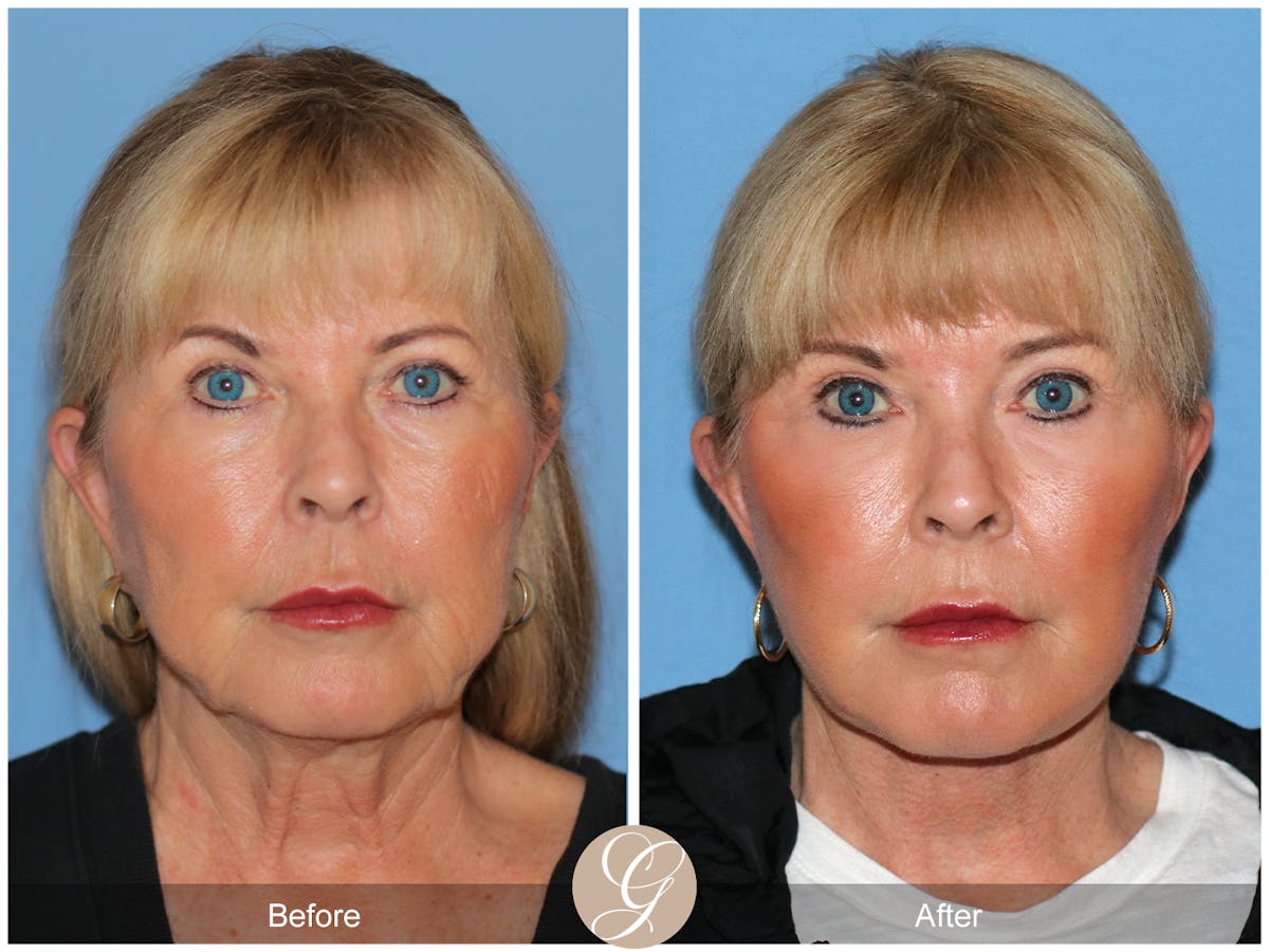 Preservation Facelift Before & After Gallery - Patient 220003 - Image 1