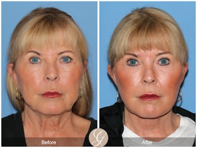 Preservation Facelift Before & After Gallery - Patient 220003 - Image 1