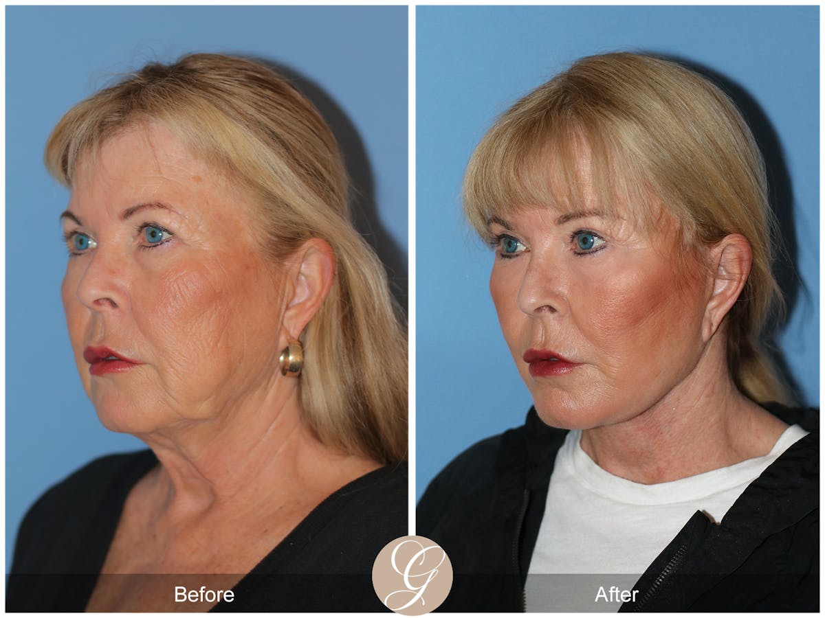 Preservation Facelift Before & After Gallery - Patient 220003 - Image 7