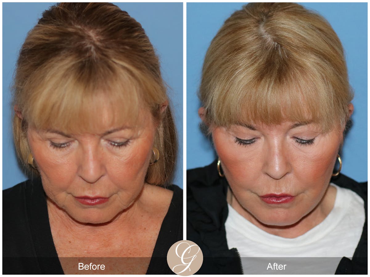 Preservation Facelift Before & After Gallery - Patient 220003 - Image 2