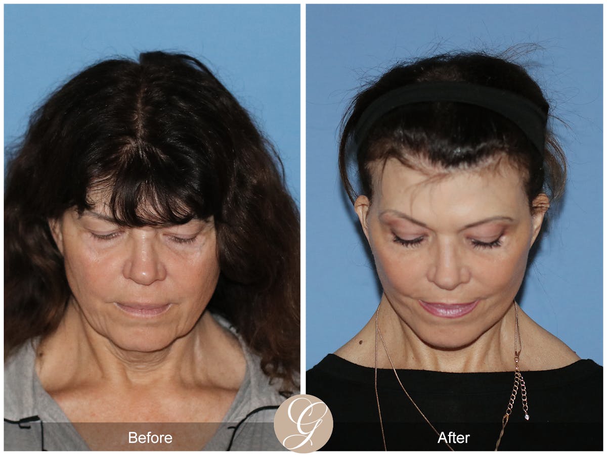 Preservation Facelift Before & After Gallery - Patient 348531 - Image 2