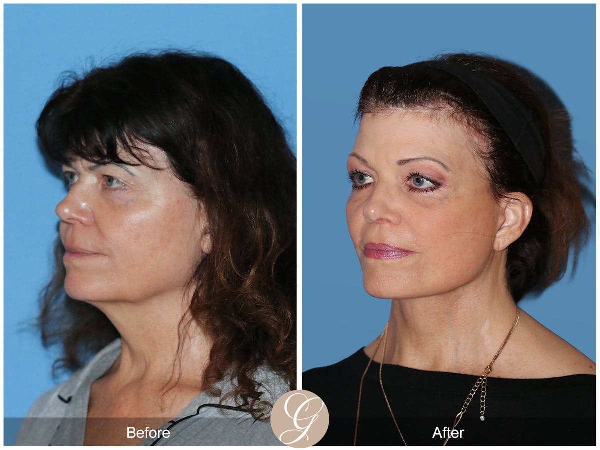 Preservation Facelift Before & After Gallery - Patient 348531 - Image 5