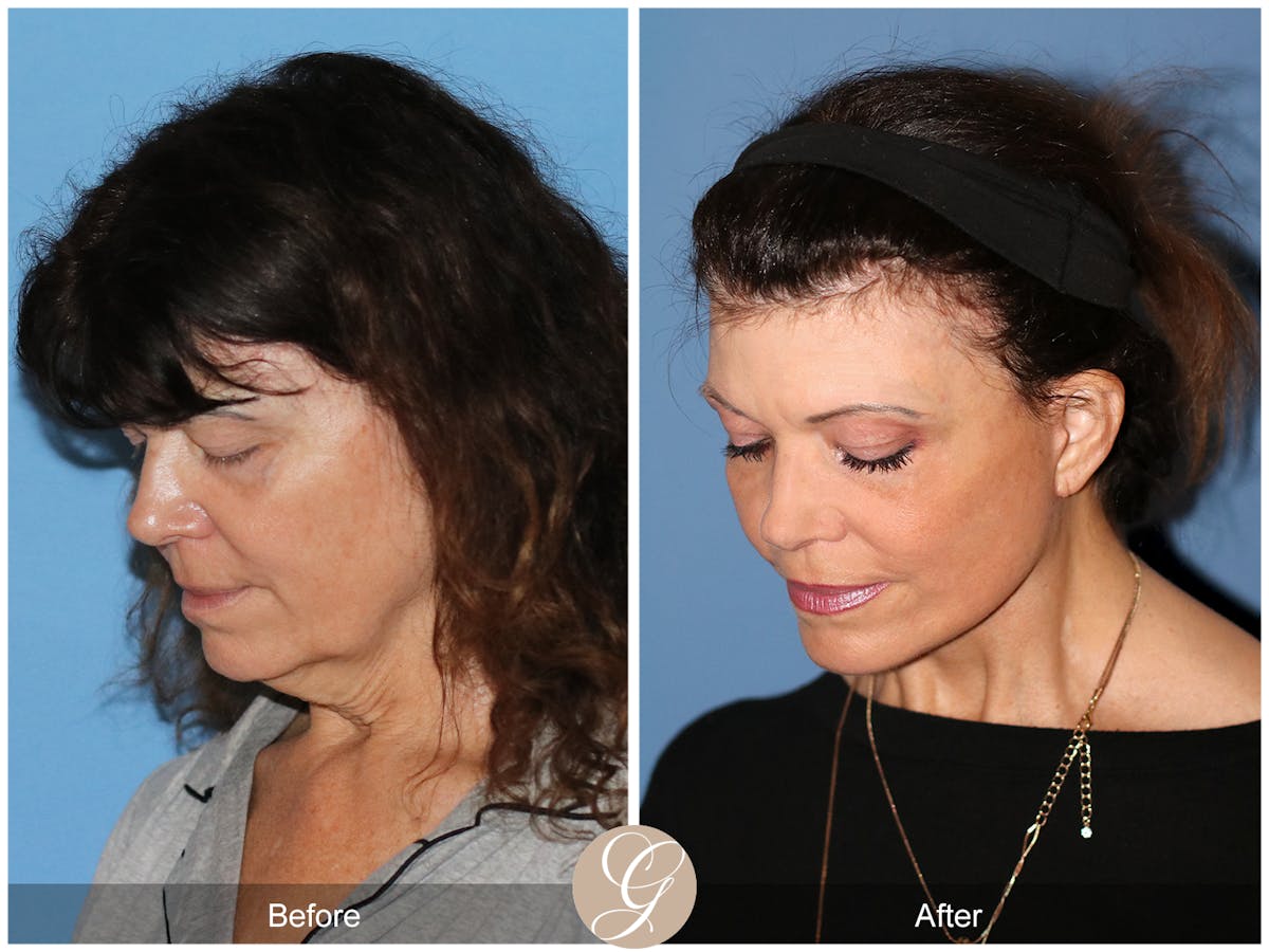 Preservation Facelift Before & After Gallery - Patient 348531 - Image 6