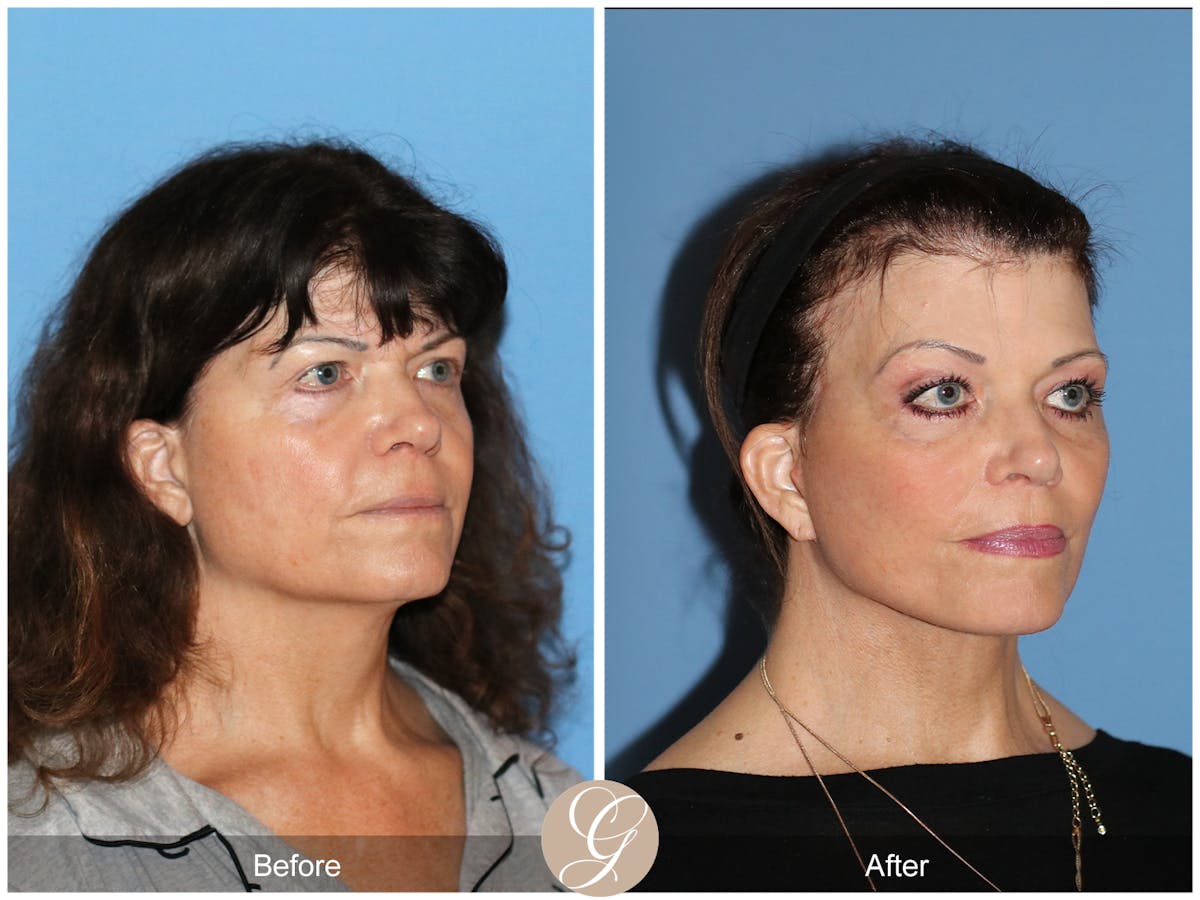 Preservation Facelift Before & After Gallery - Patient 348531 - Image 3