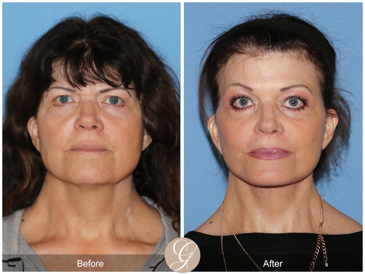 Preservation Facelift Before & After Gallery - Patient 348531 - Image 1