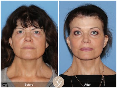 Preservation Facelift Before & After Gallery - Patient 348531 - Image 1