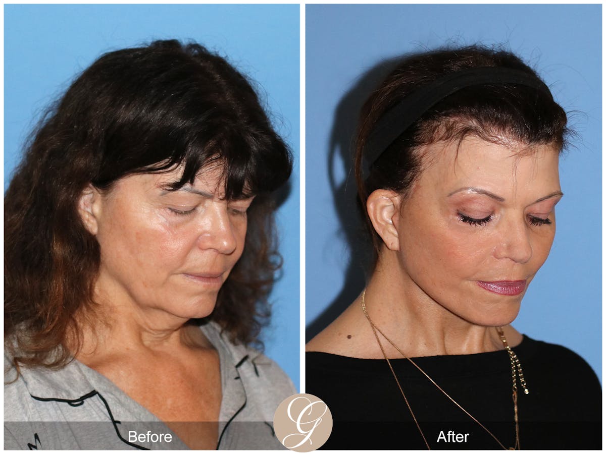 Preservation Facelift Before & After Gallery - Patient 348531 - Image 4