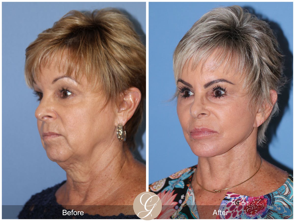 Preservation Facelift Before & After Gallery - Patient 253698 - Image 4