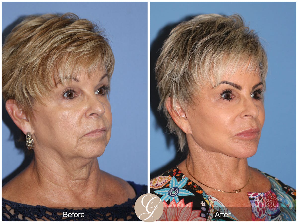 Preservation Facelift Before & After Gallery - Patient 253698 - Image 2