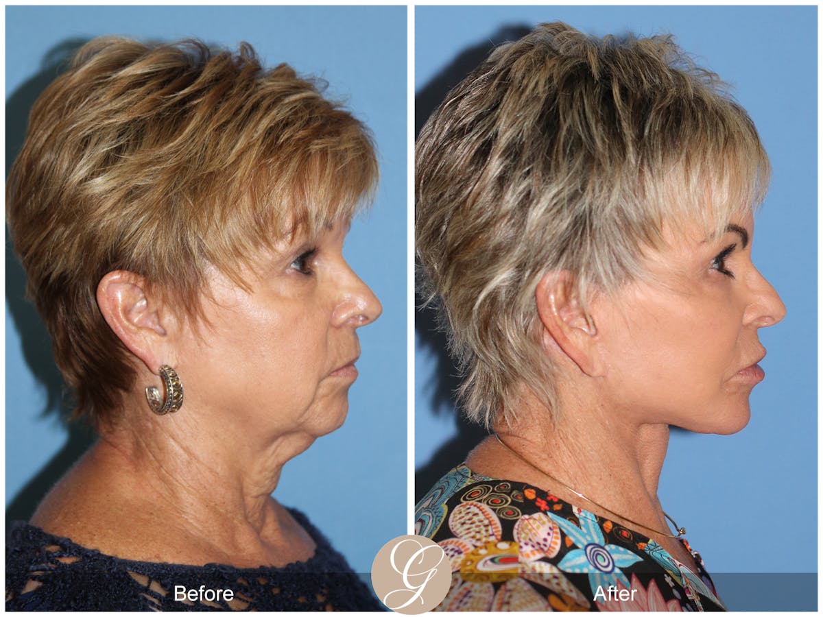Preservation Facelift Before & After Gallery - Patient 253698 - Image 3