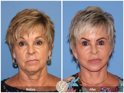 Preservation Facelift Before & After Gallery - Patient 253698 - Image 1