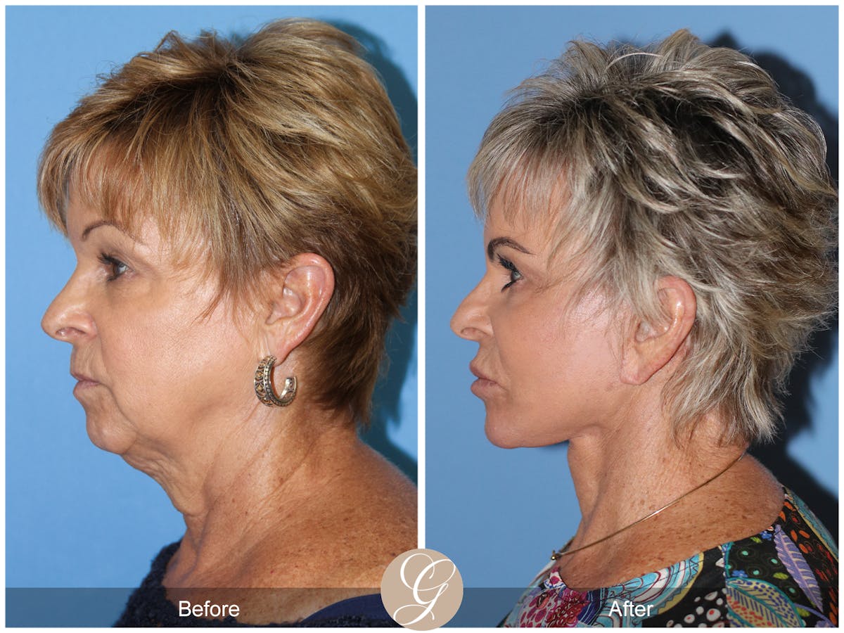 Preservation Facelift Before & After Gallery - Patient 253698 - Image 5