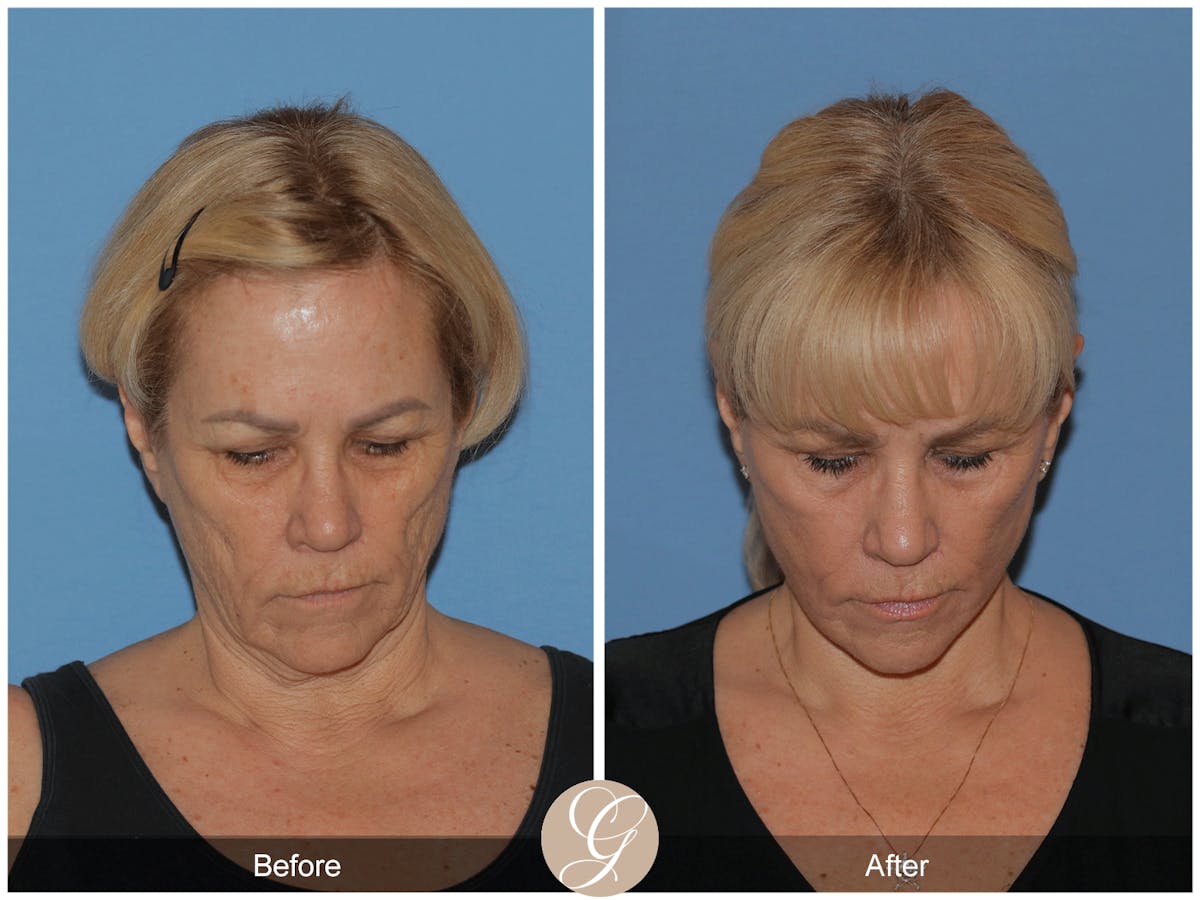 Deep Plane Facelift Before & After Gallery - Patient 154892 - Image 3