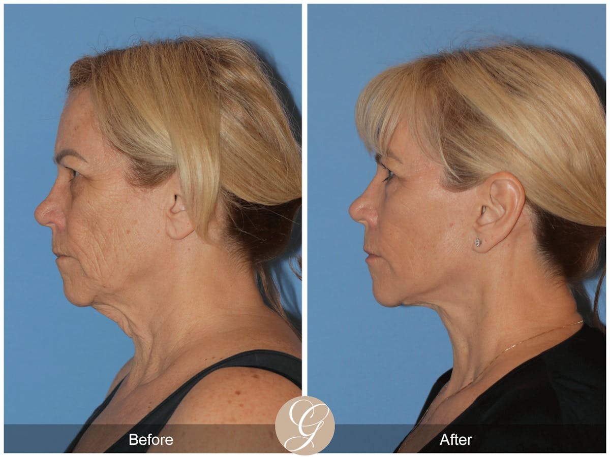 Deep Plane Facelift Before & After Gallery - Patient 154892 - Image 10