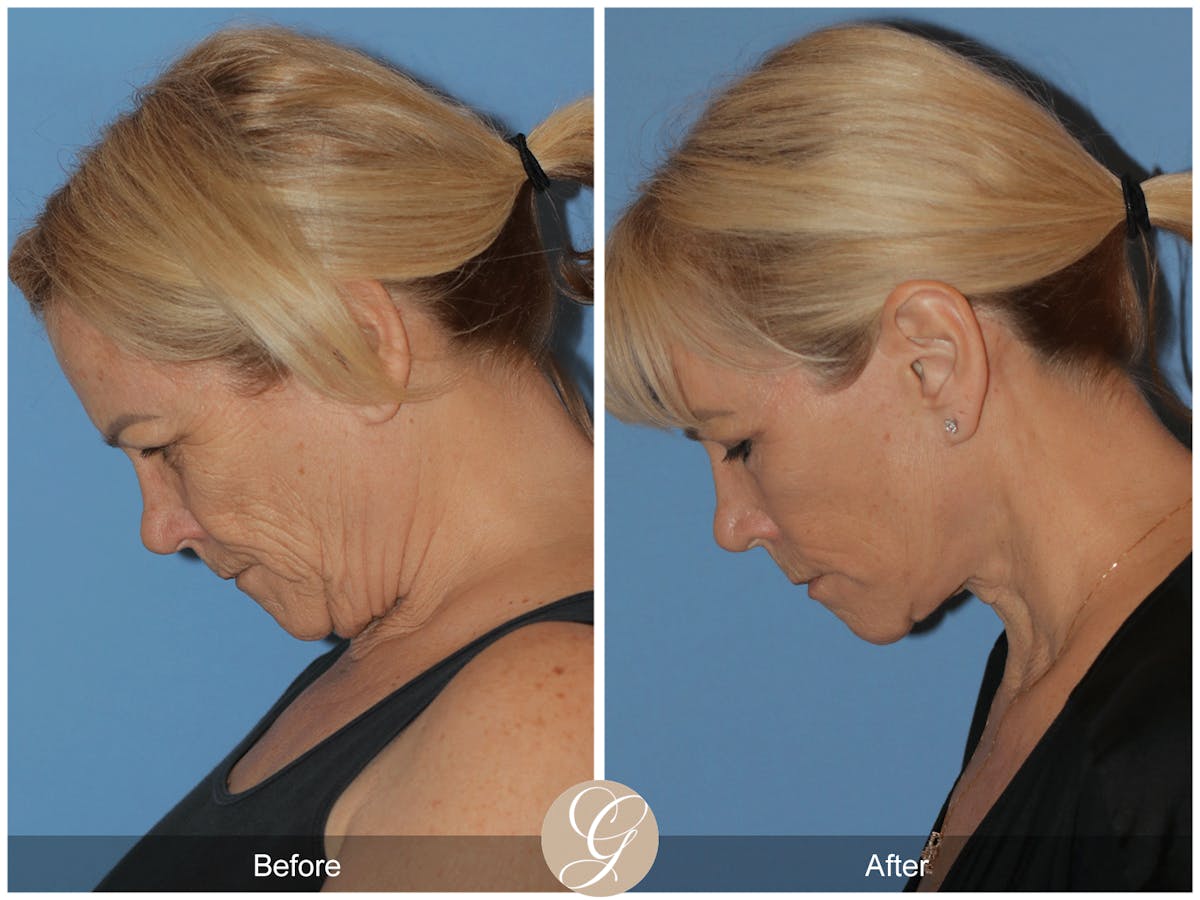 Deep Plane Facelift Before & After Gallery - Patient 154892 - Image 11