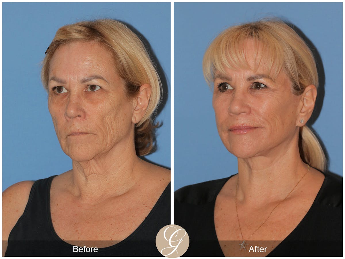 Deep Plane Facelift Before & After Gallery - Patient 154892 - Image 8