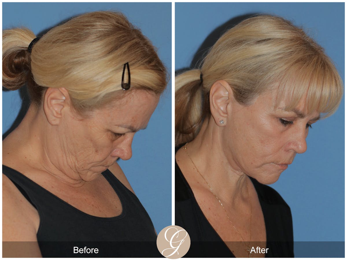 Deep Plane Facelift Before & After Gallery - Patient 154892 - Image 5