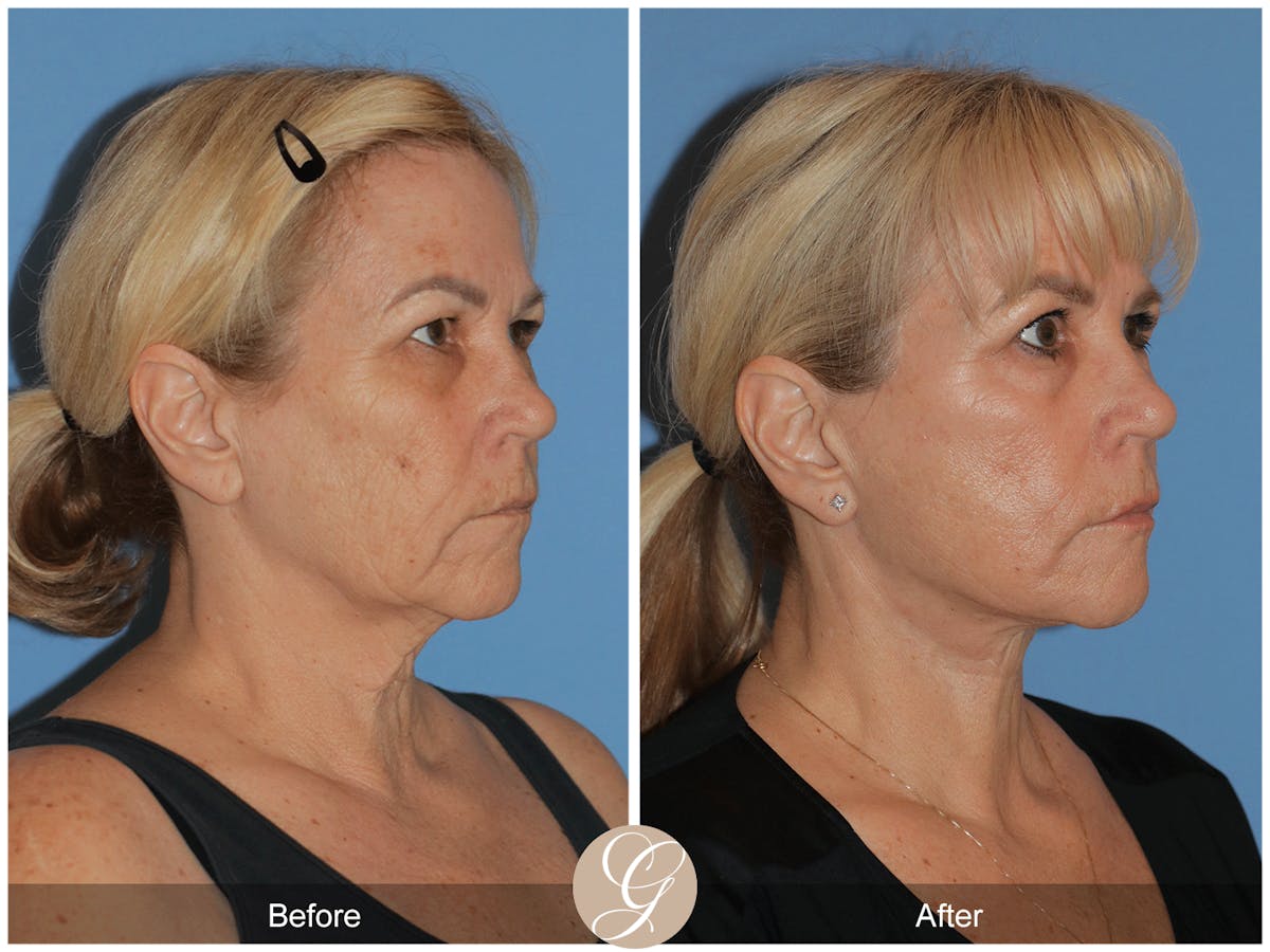Deep Plane Facelift Before & After Gallery - Patient 154892 - Image 4