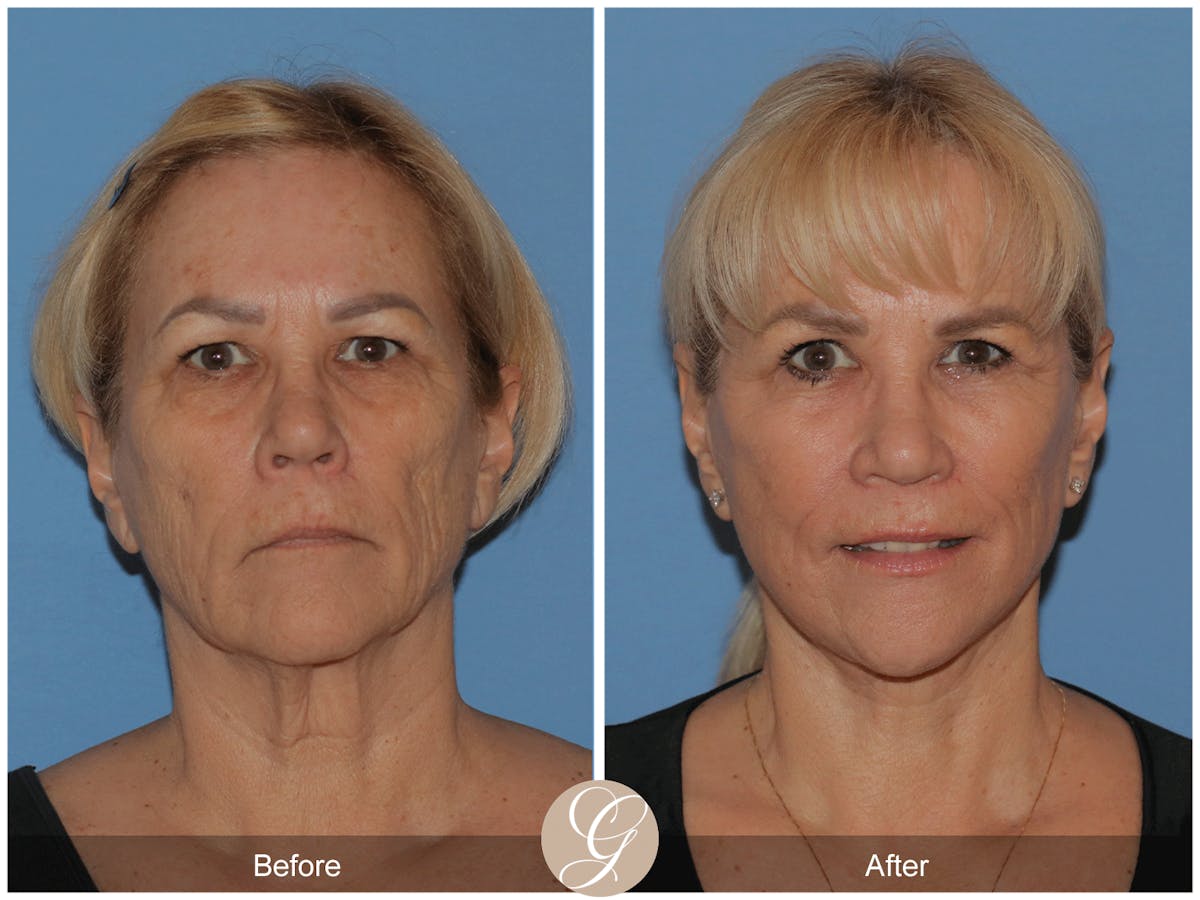 Deep Plane Facelift Before & After Gallery - Patient 154892 - Image 1