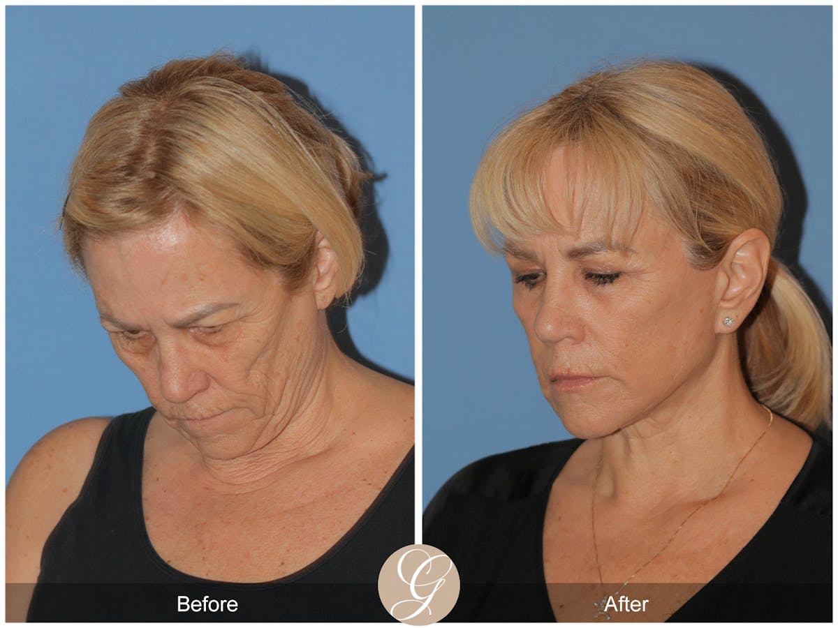 Deep Plane Facelift Before & After Gallery - Patient 154892 - Image 9