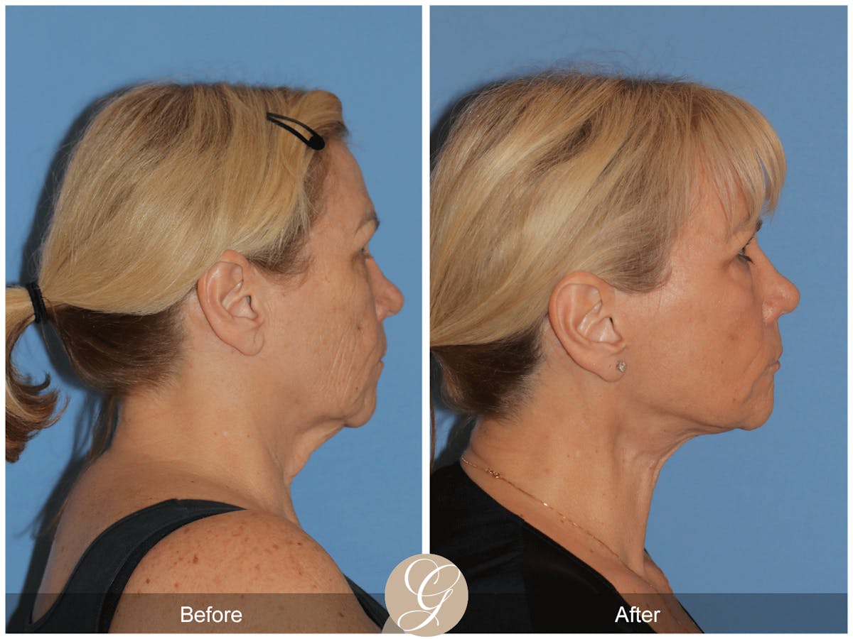 Deep Plane Facelift Before & After Gallery - Patient 154892 - Image 6