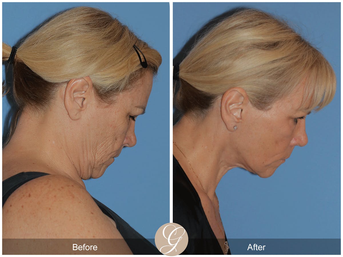 Deep Plane Facelift Before & After Gallery - Patient 154892 - Image 7