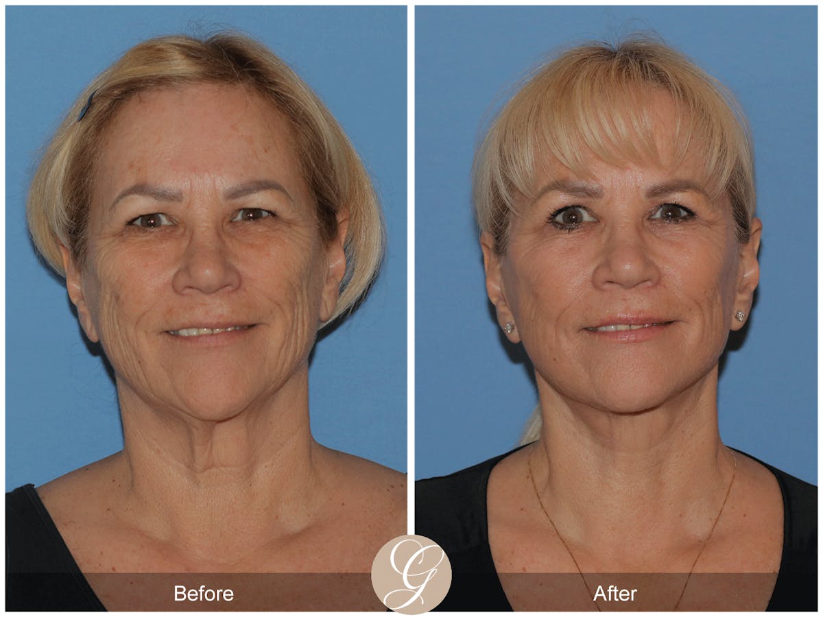 Deep Plane Facelift Before & After Gallery - Patient 154892 - Image 2