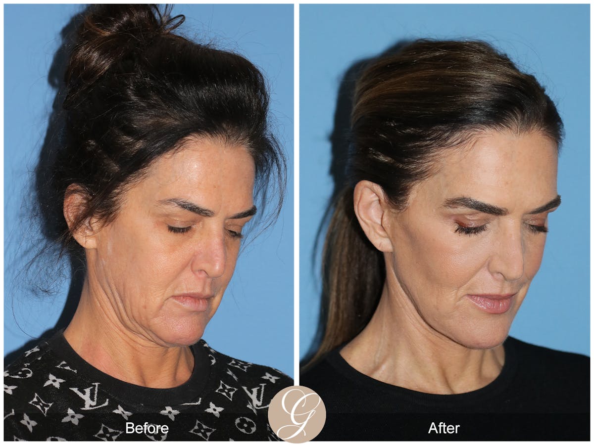Preservation Facelift Before & After Gallery - Patient 579251 - Image 4