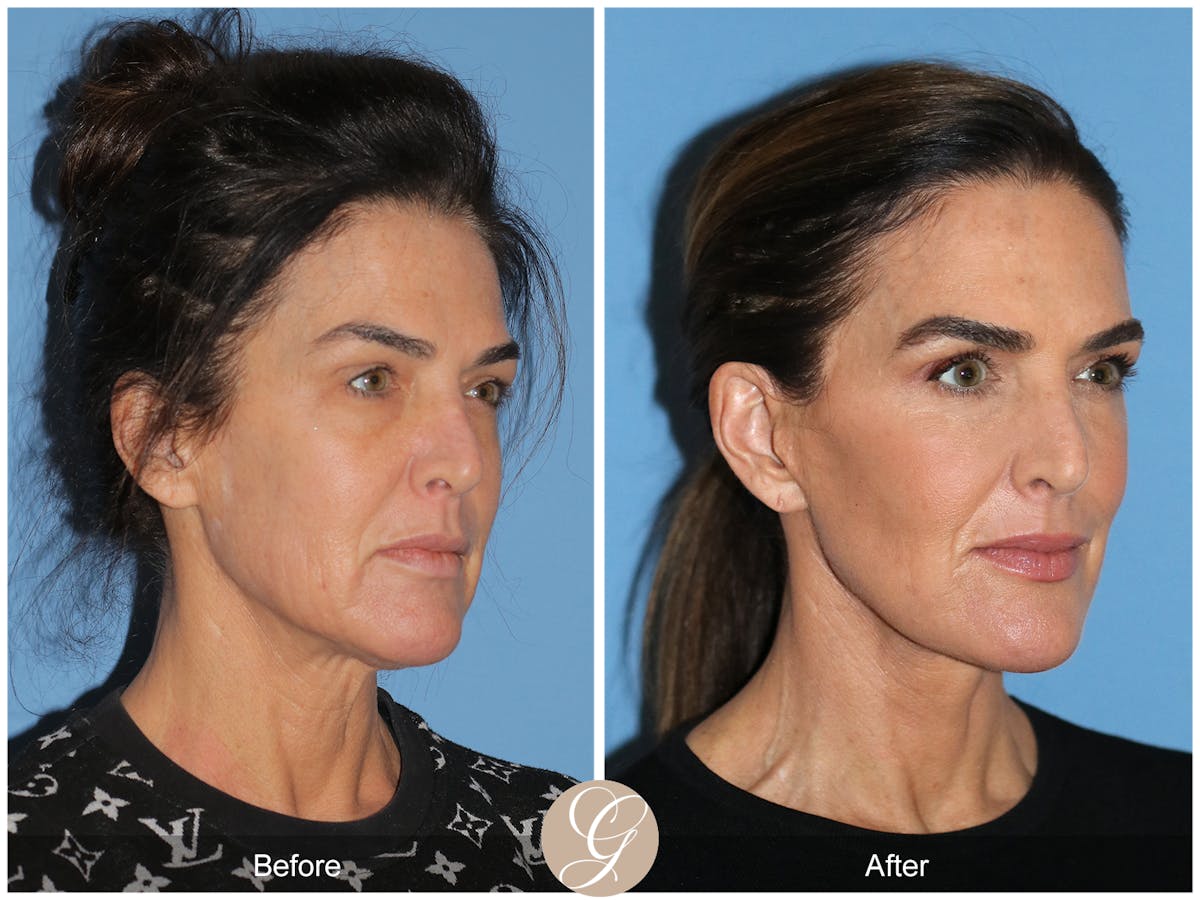 Preservation Facelift Before & After Gallery - Patient 579251 - Image 3