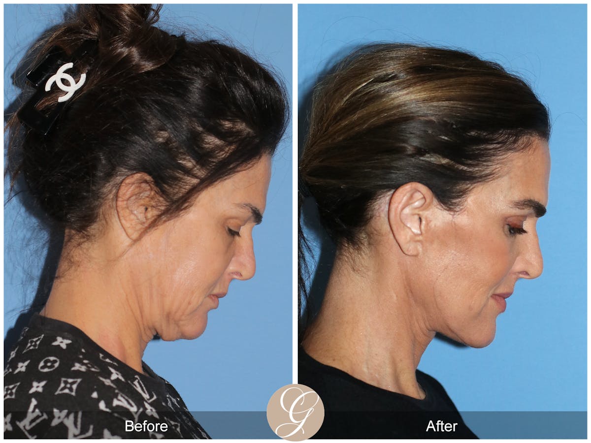 Preservation Facelift Before & After Gallery - Patient 579251 - Image 6