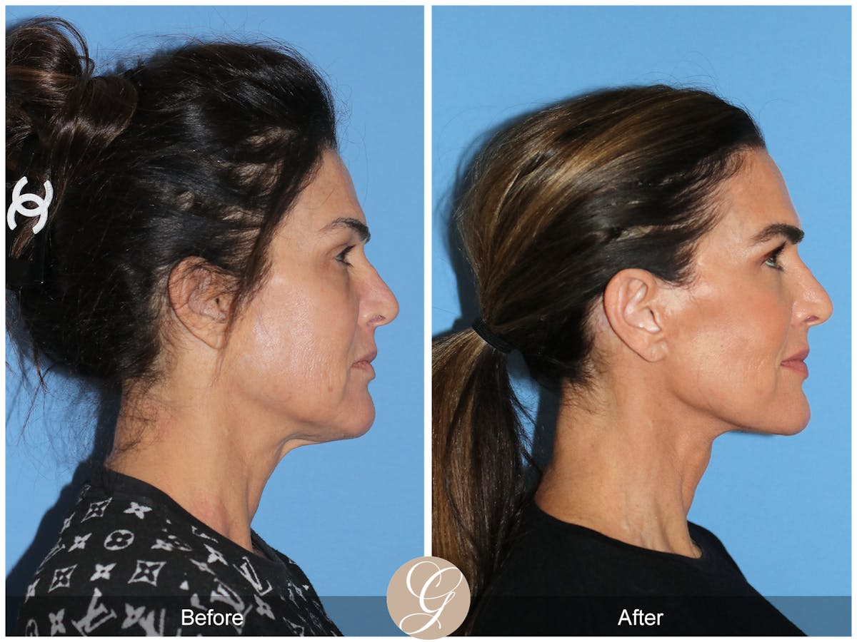 Preservation Facelift Before & After Gallery - Patient 579251 - Image 5