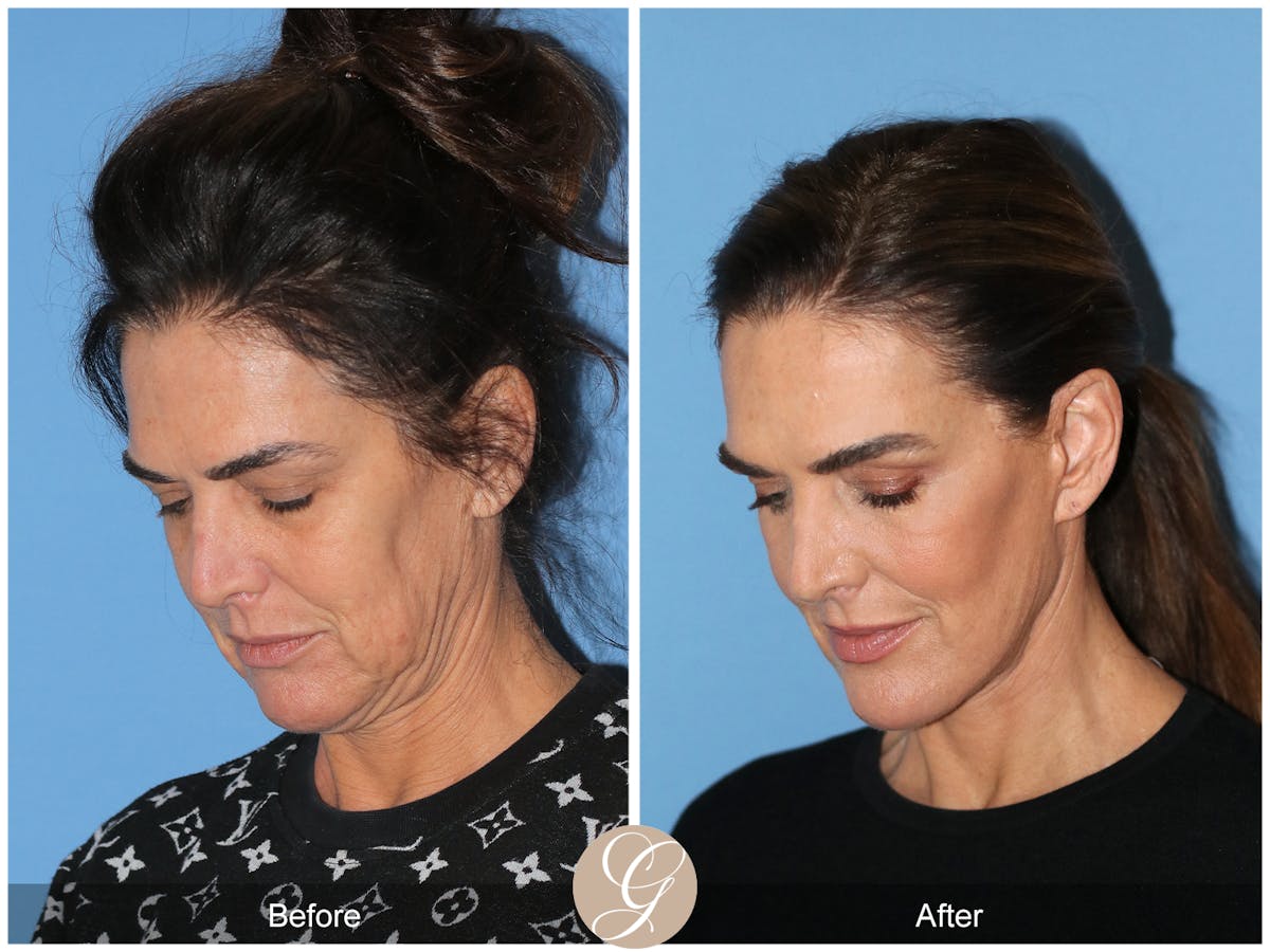 Preservation Facelift Before & After Gallery - Patient 579251 - Image 8