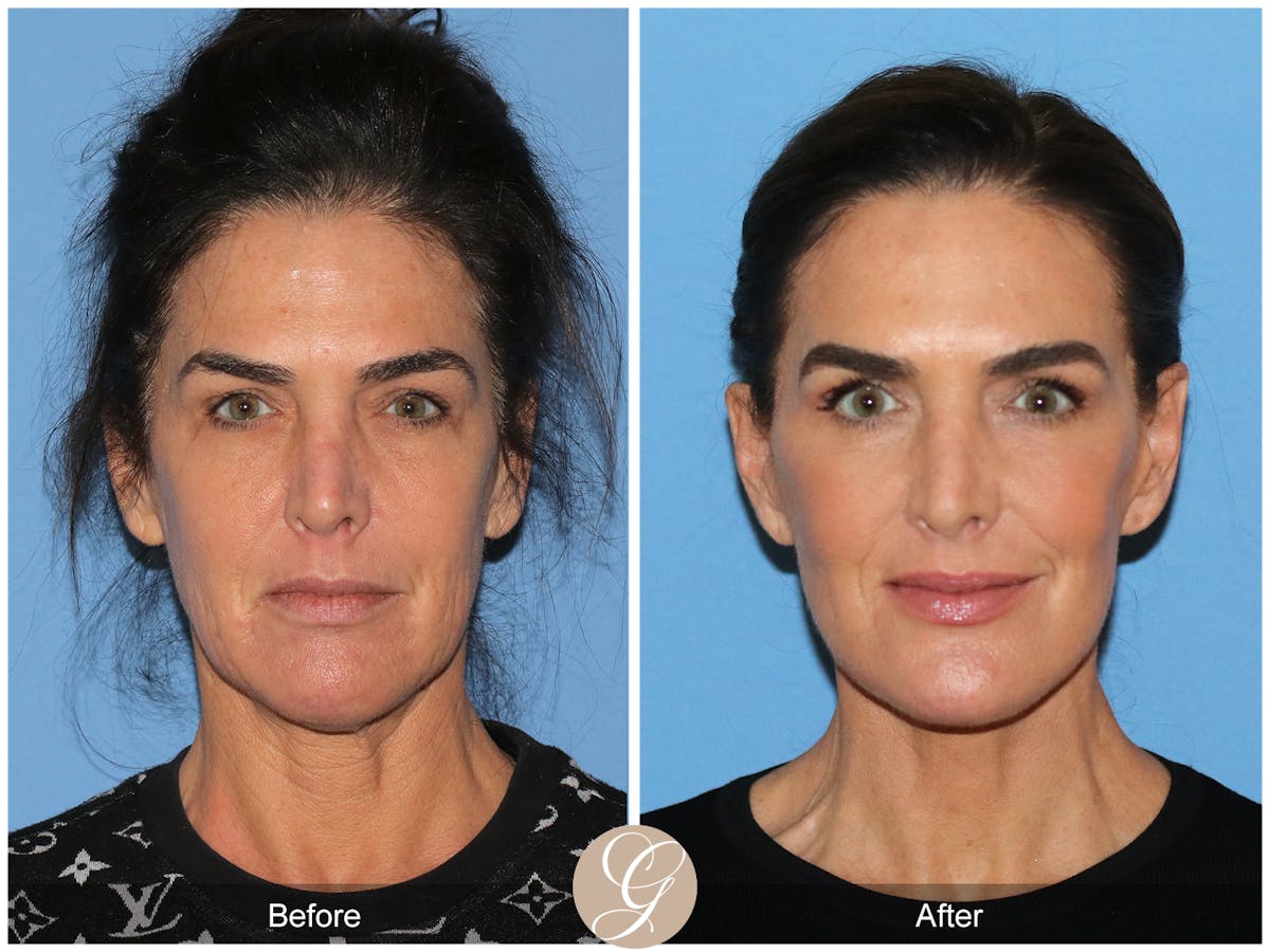 Preservation Facelift Before & After Gallery - Patient 579251 - Image 1