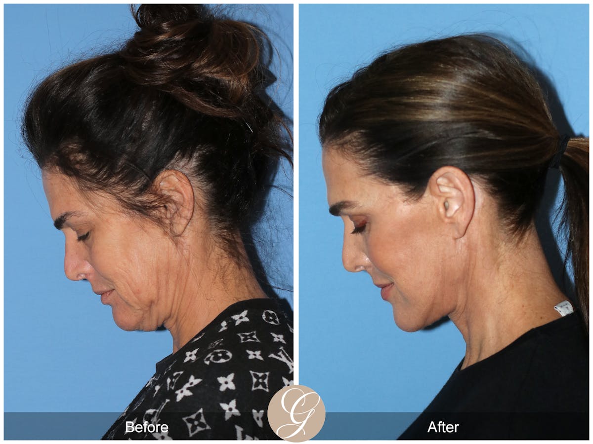Preservation Facelift Before & After Gallery - Patient 579251 - Image 10