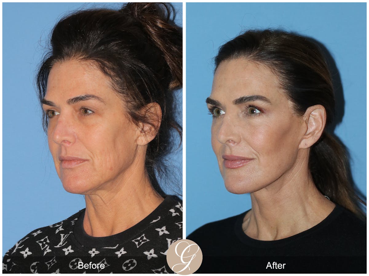 Preservation Facelift Before & After Gallery - Patient 579251 - Image 7