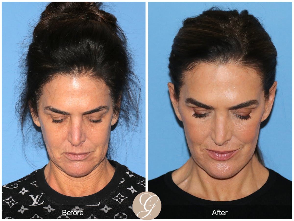 Preservation Facelift Before & After Gallery - Patient 579251 - Image 2