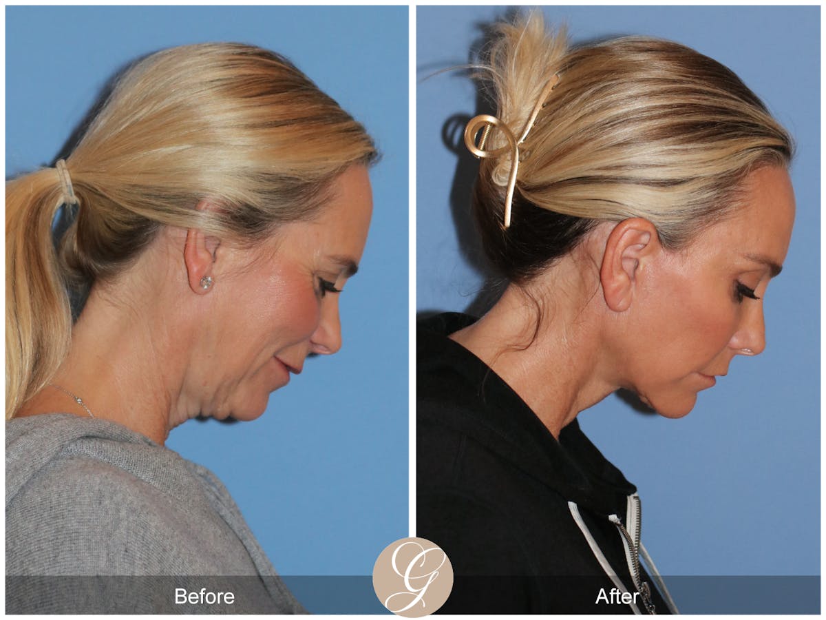 Deep Plane Facelift Before & After Gallery - Patient 426735 - Image 6