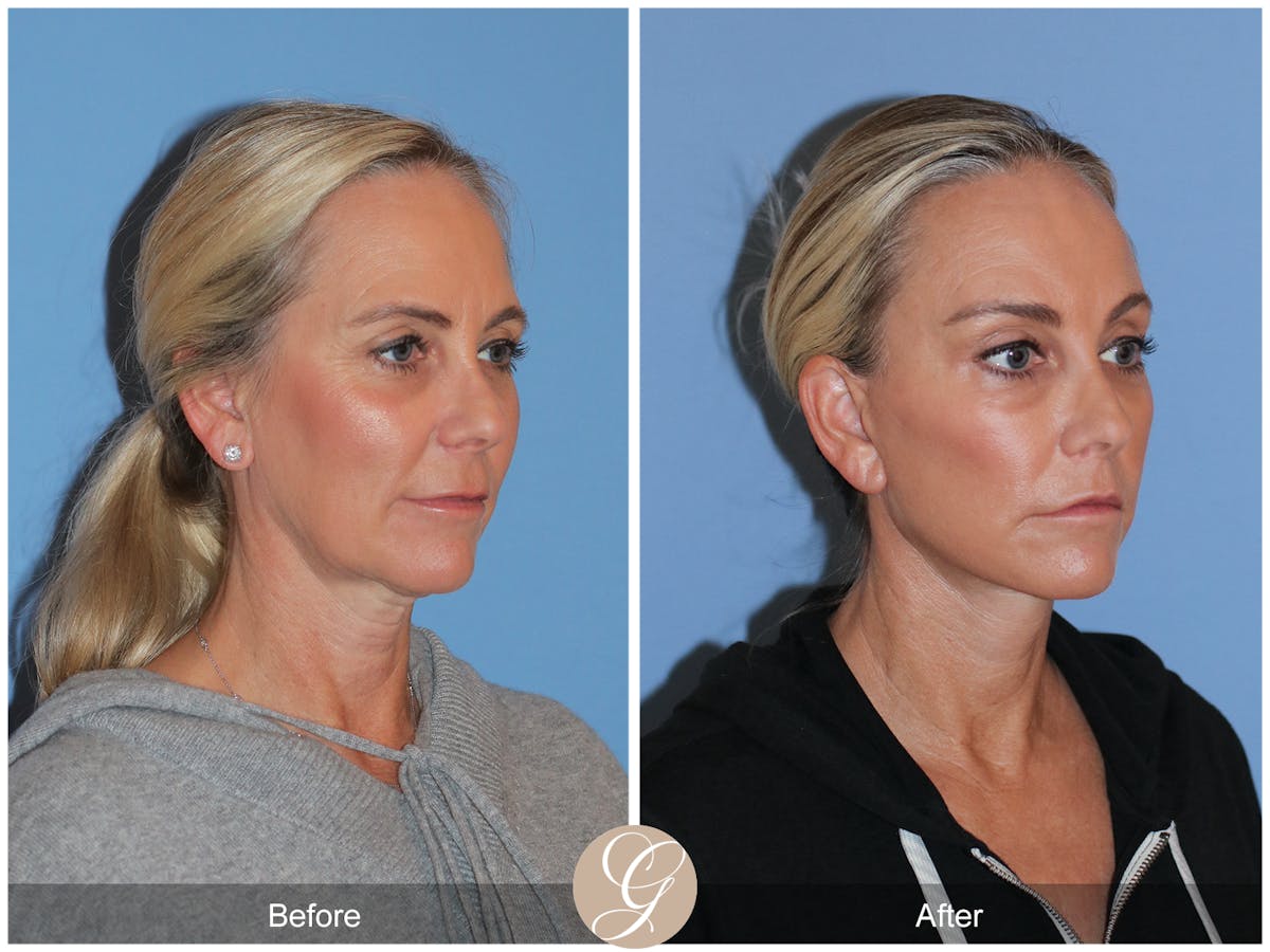 Deep Plane Facelift Before & After Gallery - Patient 426735 - Image 4