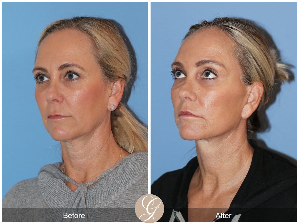 Deep Plane Facelift Before & After Gallery - Patient 426735 - Image 7