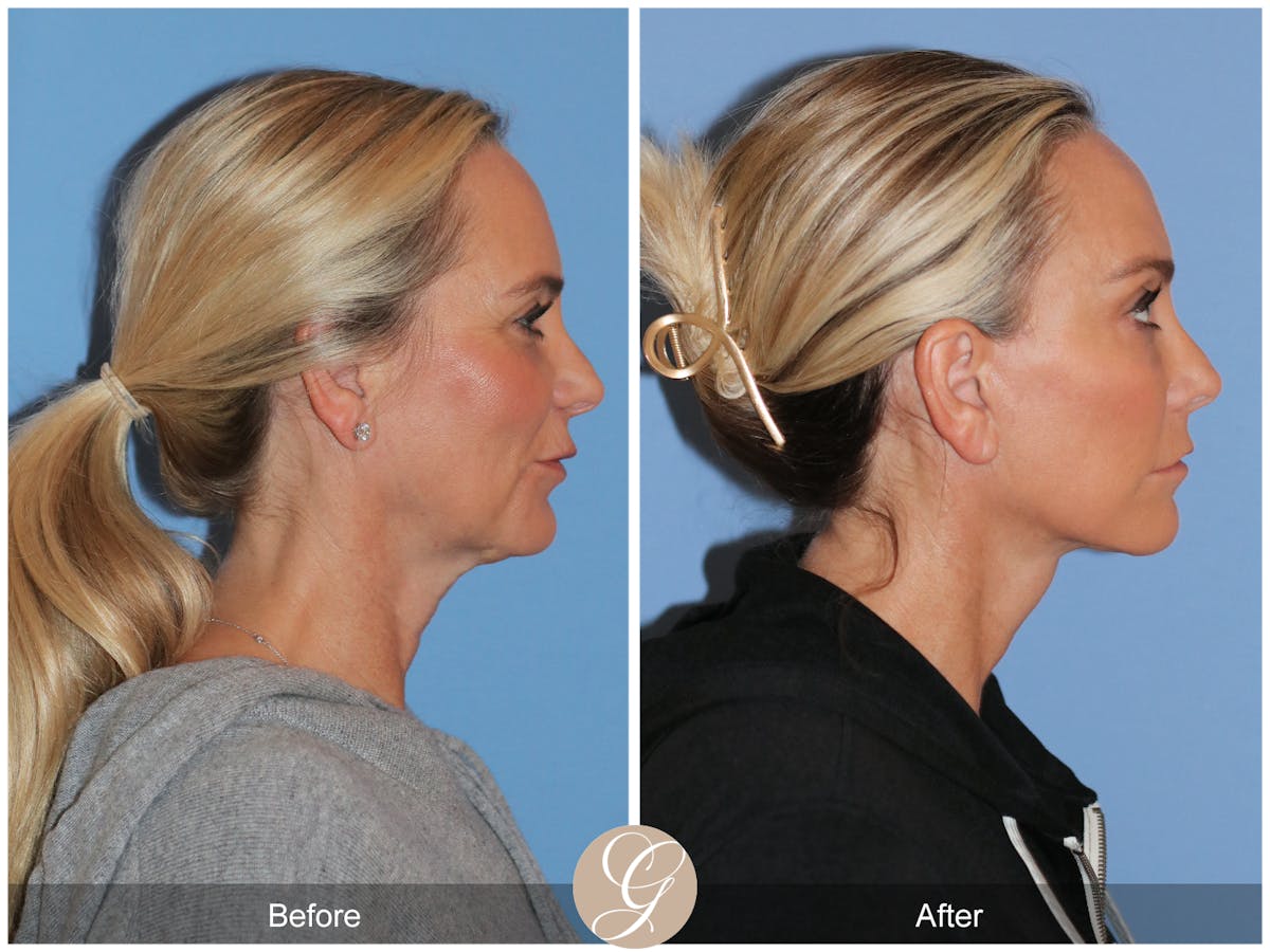Deep Plane Facelift Before & After Gallery - Patient 426735 - Image 5