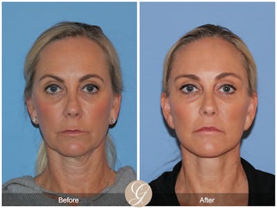 Deep Plane Facelift Before & After Gallery - Patient 426735 - Image 1