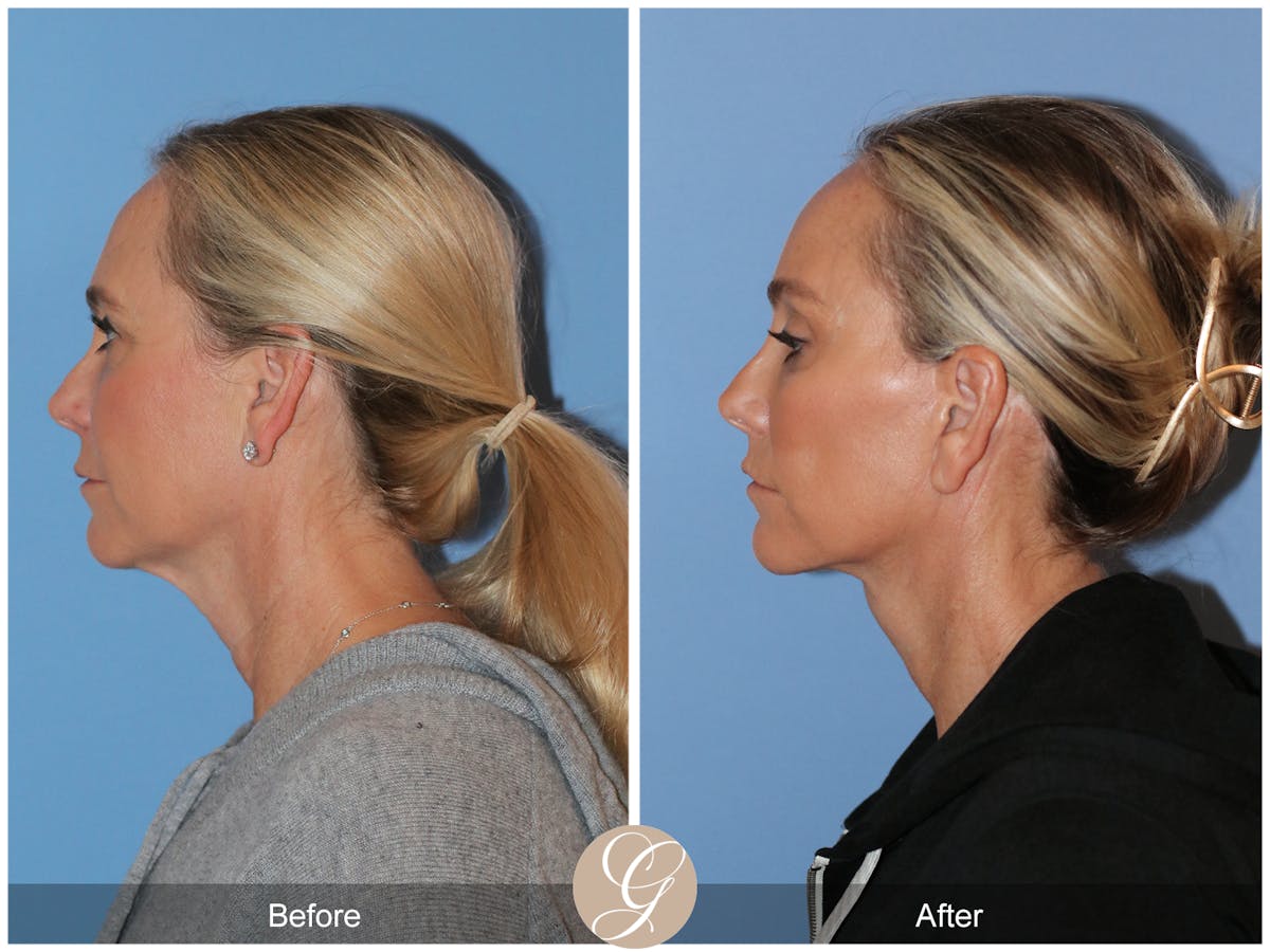 Deep Plane Facelift Before & After Gallery - Patient 426735 - Image 8