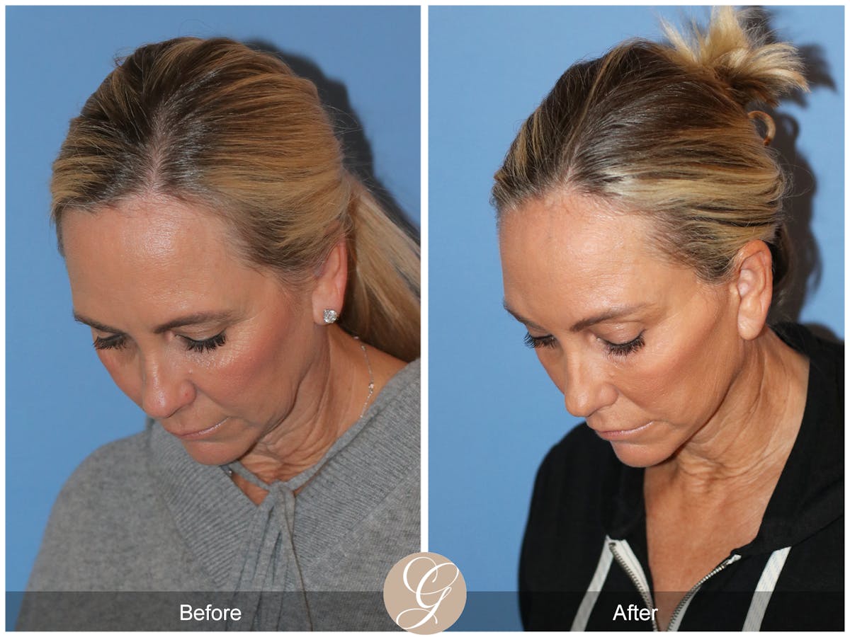 Deep Plane Facelift Before & After Gallery - Patient 426735 - Image 9