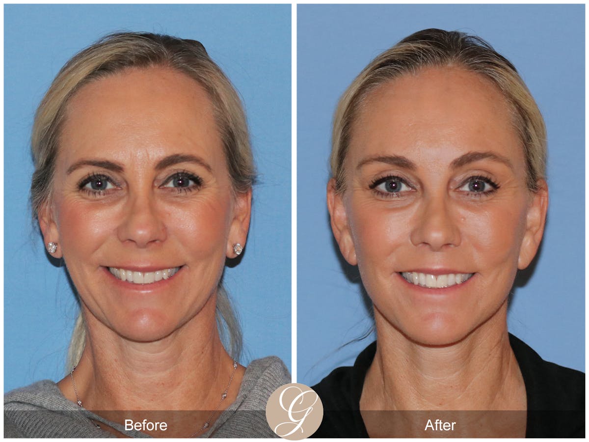 Deep Plane Facelift Before & After Gallery - Patient 426735 - Image 2