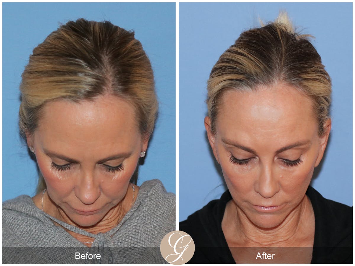Deep Plane Facelift Before & After Gallery - Patient 426735 - Image 3