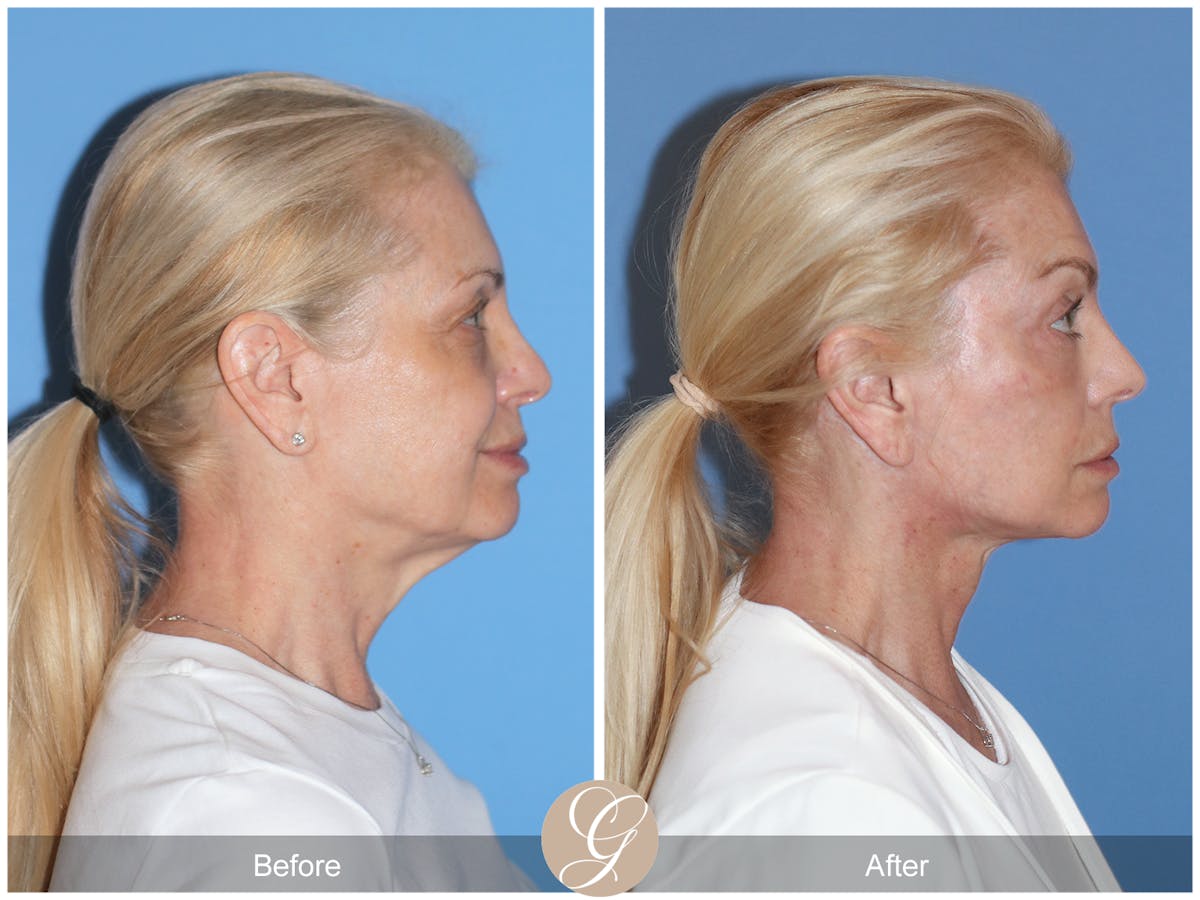 Preservation Facelift Before & After Gallery - Patient 306280 - Image 5