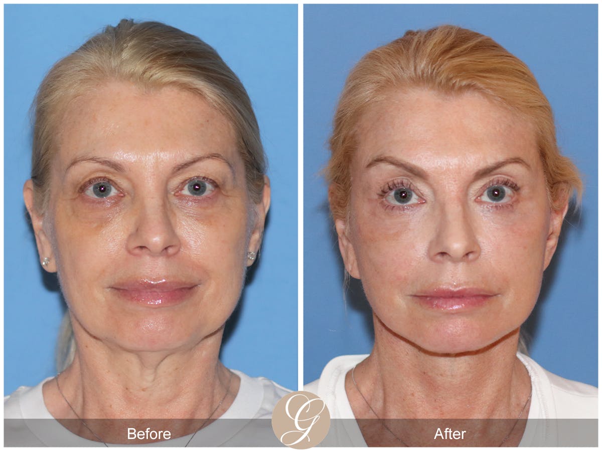 Preservation Facelift Before & After Gallery - Patient 306280 - Image 1