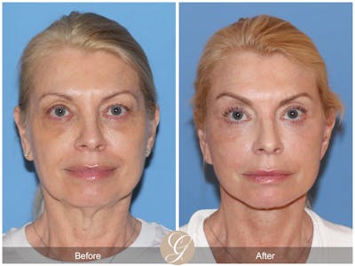 Preservation Facelift Before & After Gallery - Patient 306280 - Image 1