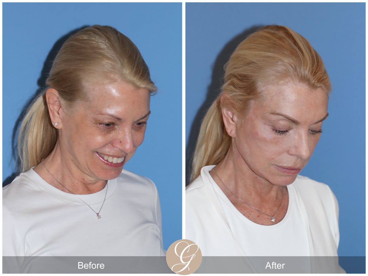 Preservation Facelift Before & After Gallery - Patient 306280 - Image 4